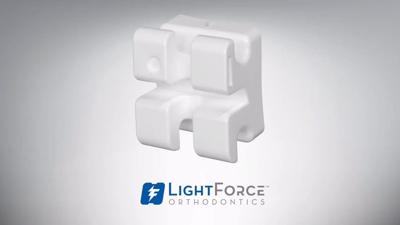 来自Lightforce Orthodontics的3D印刷支具。照片通过Playforce Orthodontics。