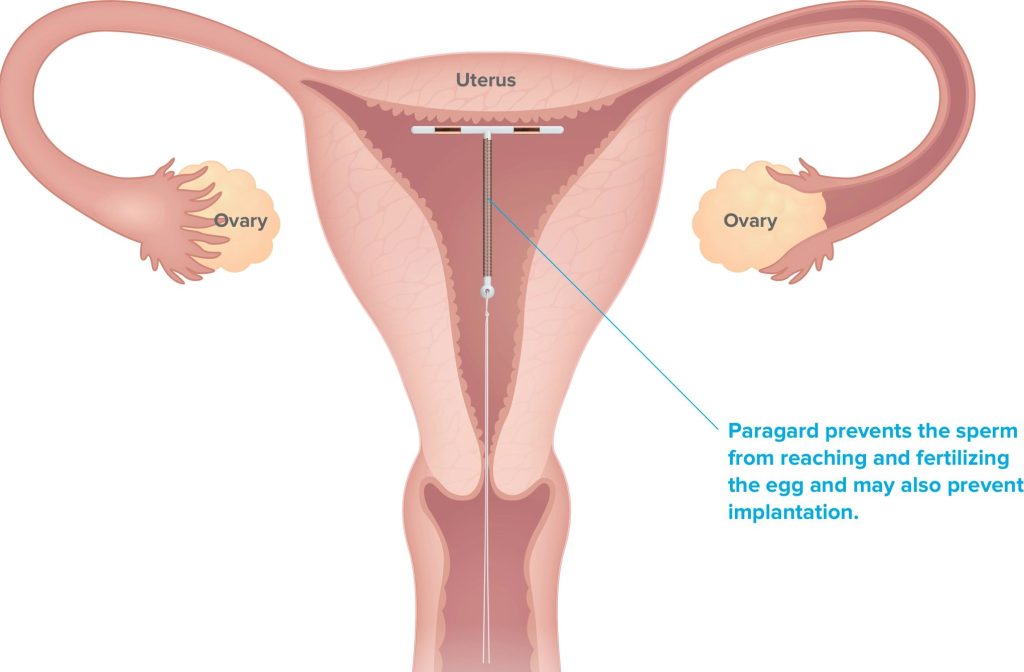 A diagram indicating how ParaGard's commercial IUD works. Image via ParaGard.