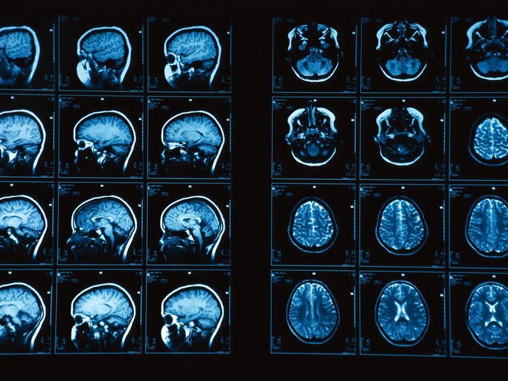 Ken Glasercorbis的Brain MRI扫描照片，通过：国家地理