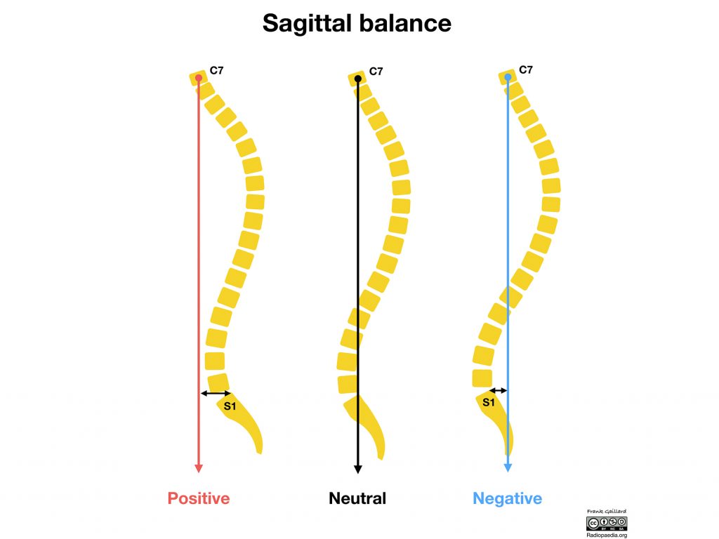 Diagram showing positive and negative sagittal imbalance in comparison to neutral spin positioning. Image via radiopaedia.org