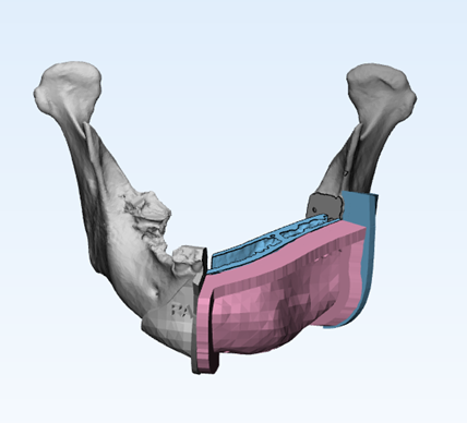 规划带有3D打印植入物和骨移植物的下颌的重建。图片通过奥利弗·伯利（Oliver Burley）