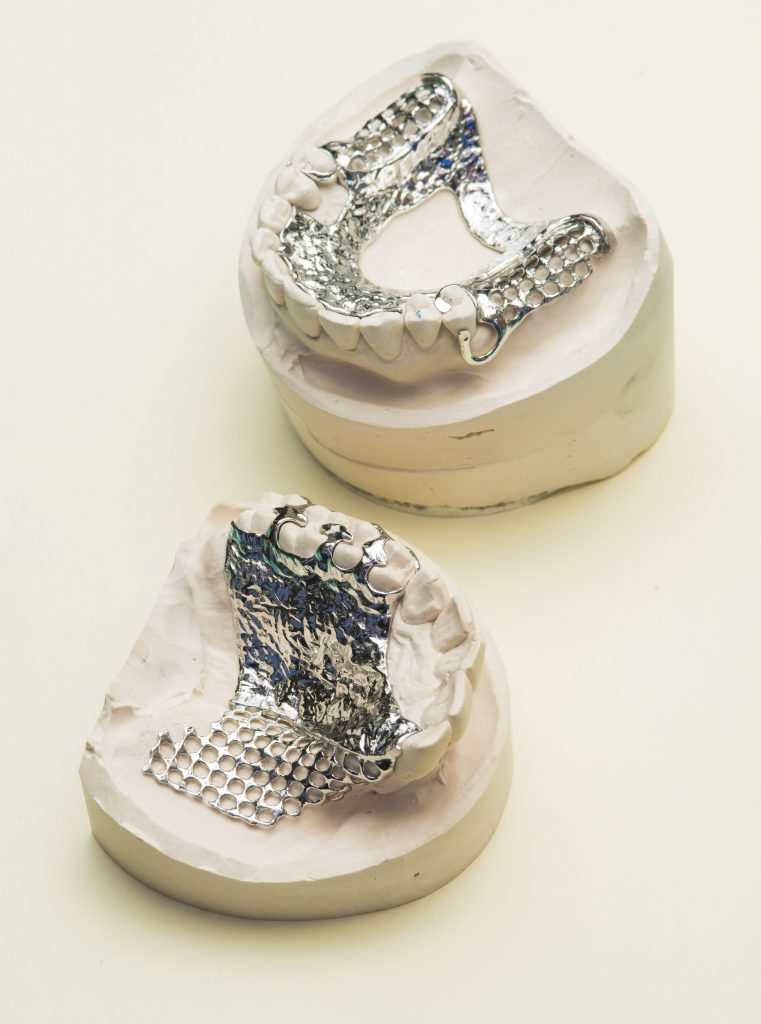COCR 3D打印可移动的部分义齿。通过Renishaw的照片。
