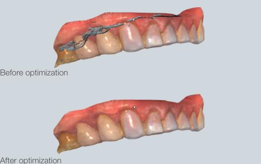 使用Aoralscan 3D扫描软件对口腔内扫描进行了优化。图像通过闪亮3d。
