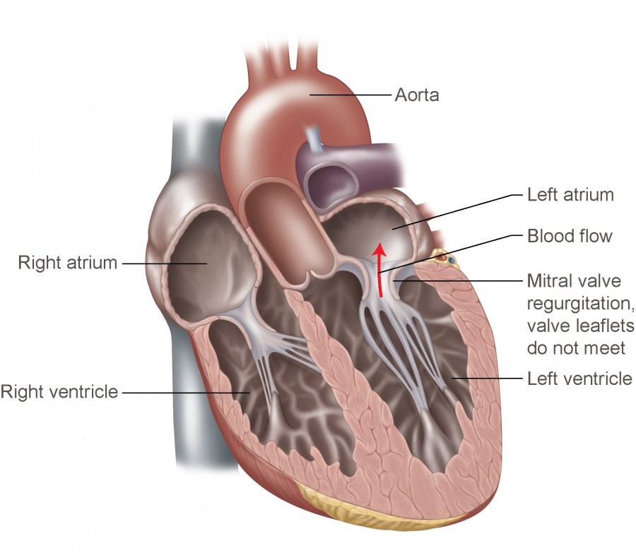 A diagram of mitral valve regurgitation disease. Image via Temple Health.