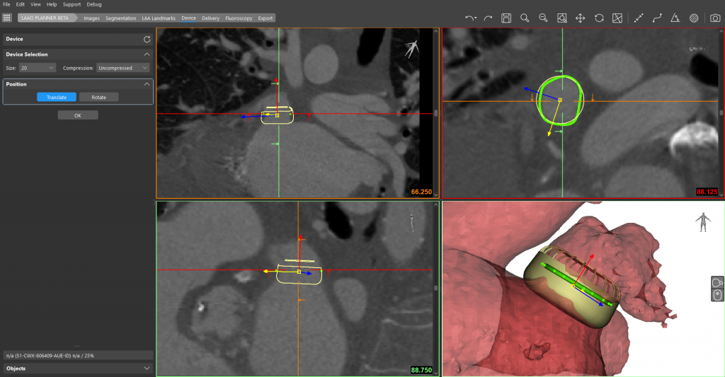 Performing a virtual LAAO device implantation in Mimics Enlight. Image via Materialise.