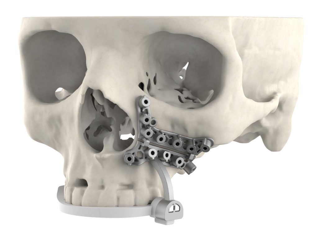 3 d系统的颌面外科指导to a skull model. Image via 3D Systems.