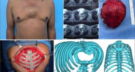 Entire sternum ribs reconstruction using a 3D printed custom-made titanium implant. Image via Manipal Hospitals.
