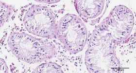 研究中NOA患者的睾丸细胞活检。通过不列颠哥伦比亚大学的照片。