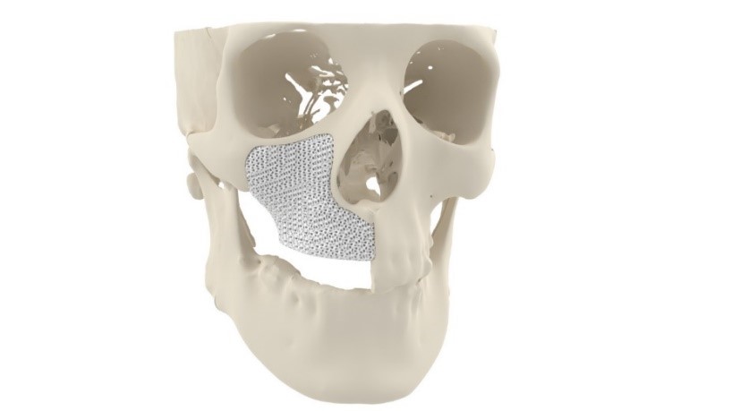 Cerhum的Mybone 3D打印的面部骨移植。通过Cerhum图像。