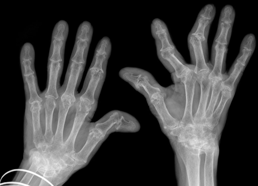 It's thought the team's 3D printed implants could be used to treat rheumatoid arthritis patients. Image via Fraunhofer-Gesellschaft.